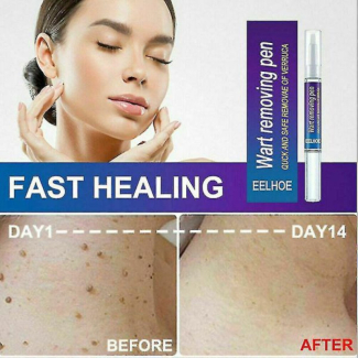 Warts Liquid Pen for Women - Effective Skin Mole and Black Dot Remover Price in Pakistan | LAPTAB