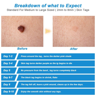 Skin Tag Remover - Safe, Natural, and Easy Home Treatment for All Areas Price in Pakistan | LAPTAB